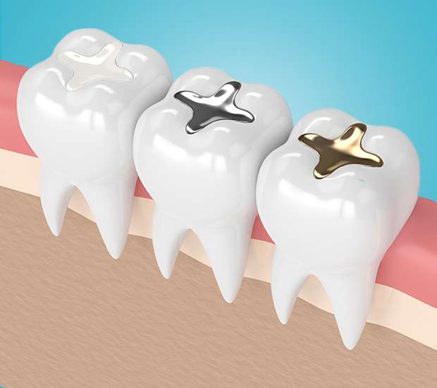 Coral Springs Composite Fillings