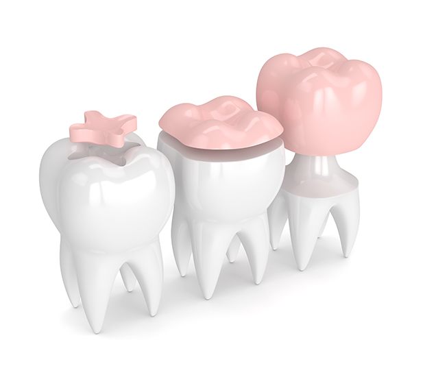 Coral Springs Dental Inlays and Onlays