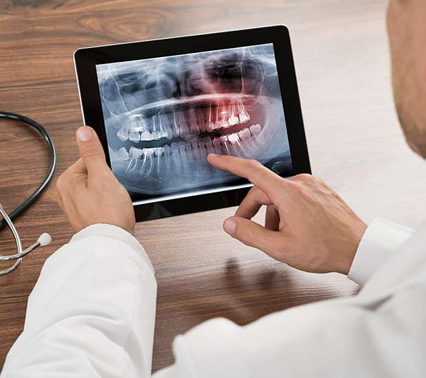 Coral Springs Types of Dental Root Fractures